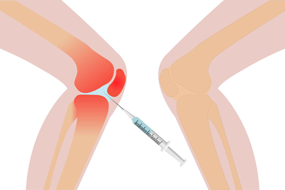 Eklem içi Enjeksiyonlar